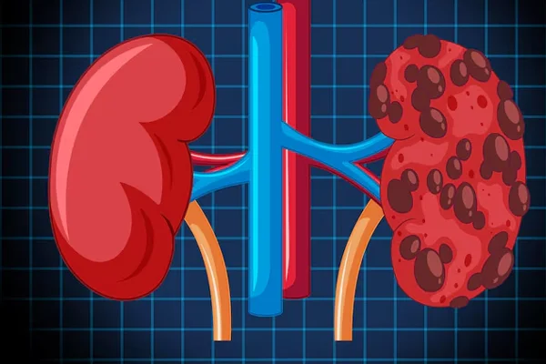 Acute Kidney Injury Management