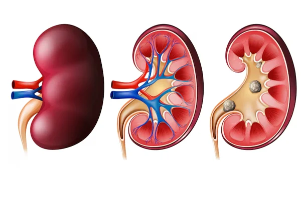 Kidney Stone Management